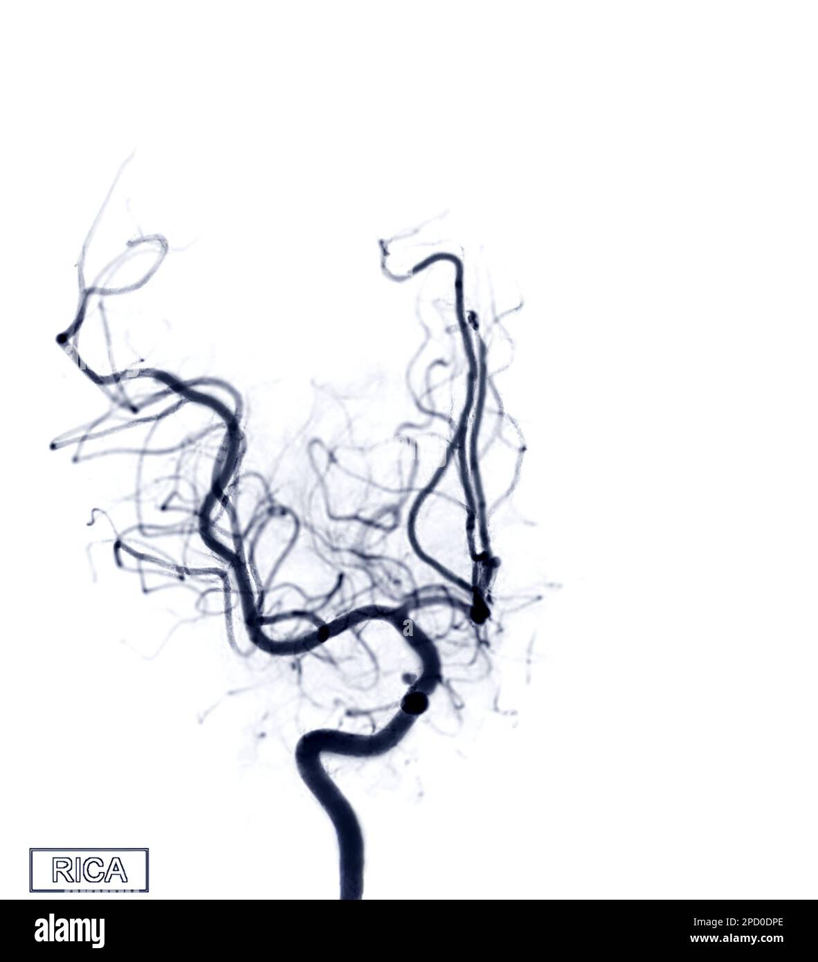 Zerebrale Angiographie von RICA aus der Durchleuchtung in der Interventionsradiologie mit Darstellung der Arteria cerebri. Stockfoto