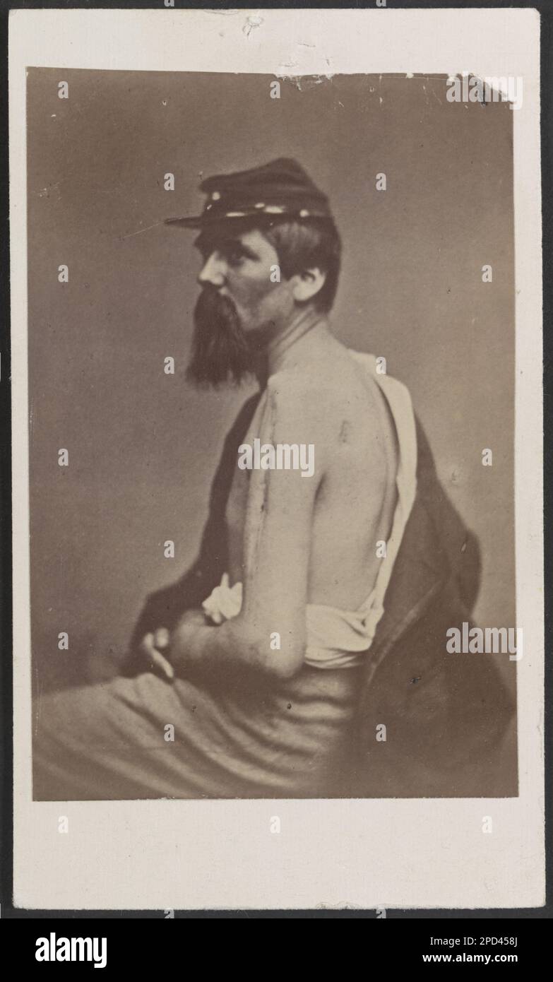 Ein Soldat namens Ewing in Kepi zeigt eine Wunde an seinem Arm / Henry Ulke, 178 Pennsylvania Avenue, Washington, D.C. Der Titel wurde von Bibliotheksmitarbeitern entwickelt. Soldaten, 1860-1870, Kriegsopfer, 1860-1870, Wunden und Verletzungen, 1860-1870, Usa, Geschichte, Bürgerkrieg, 1861-1865, Militärpersonal, USA, Geschichte, Bürgerkrieg, 1861-1865, Verletzte. Stockfoto