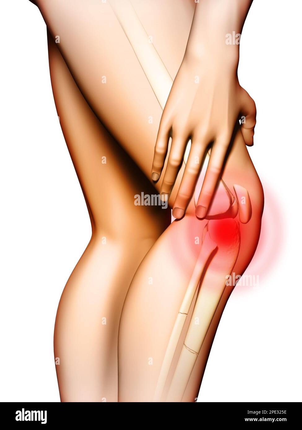 Schmerzen im Kniebereich. Die Hand berührt das Oberschenkel direkt über dem Knie. Digitale Illustration. Stockfoto