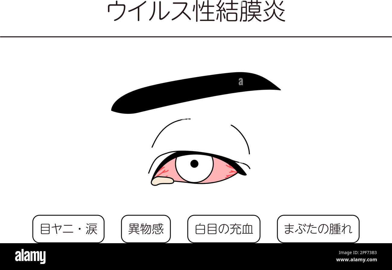 Medical Clipart, Line Drawing Illustration of Eye Disease and Viral Conjunctivitis, Vector Illustration Stock Vektor