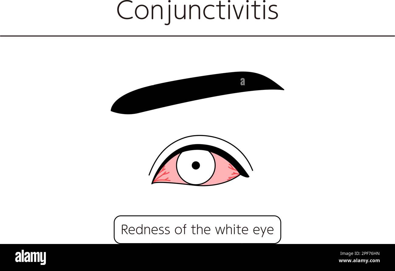Medical Clipart, Line Drawing Illustration of Eye Disease and Conjunctivitis, Vector Illustration Stock Vektor