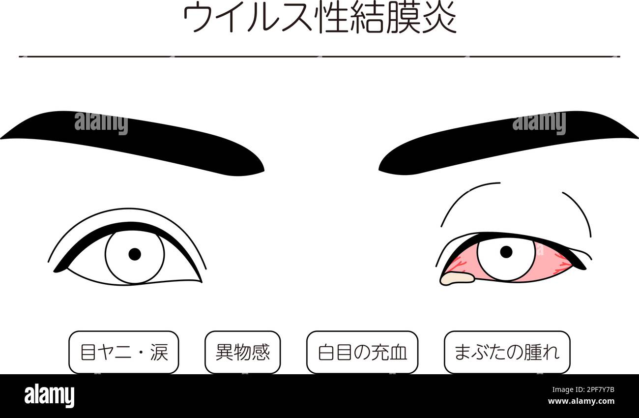 Medical Clipart, Line Drawing Illustration of Eye Disease and Viral Conjunctivitis, Vector Illustration Stock Vektor