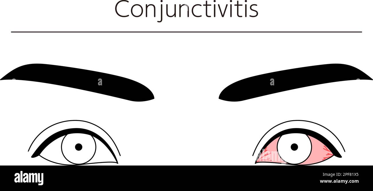 Medical Clipart, Line Drawing Illustration of Eye Disease and Conjunctivitis, Vector Illustration Stock Vektor