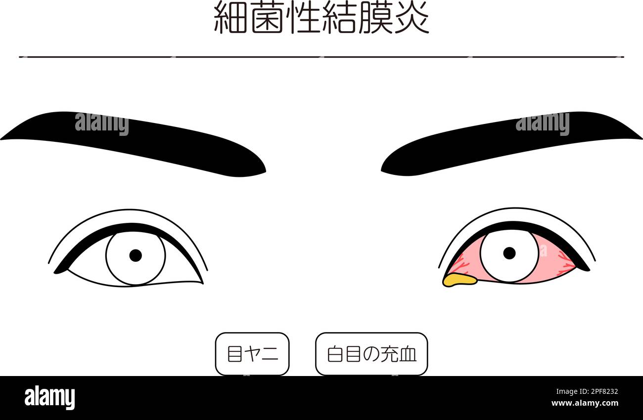 Medical Clipart, Line Drawing Illustration of Eye Disease and Bacterial Conjunctivitis, Vector Illustration Stock Vektor