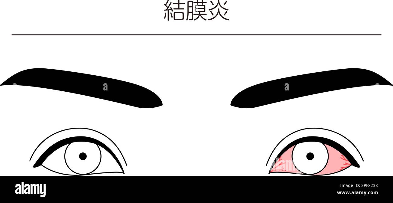 Medical Clipart, Line Drawing Illustration of Eye Disease and Conjunctivitis, Vector Illustration Stock Vektor