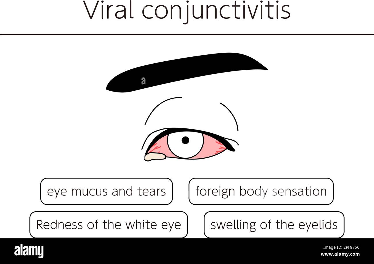 Medical Clipart, Line Drawing Illustration of Eye Disease and Viral Conjunctivitis, Vector Illustration Stock Vektor