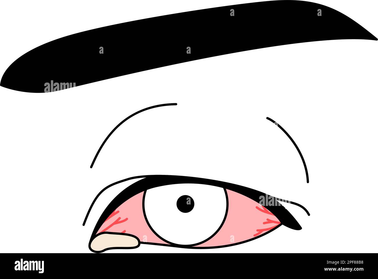 Medical Clipart, Line Drawing Illustration of Eye Disease and Viral Conjunctivitis, Vector Illustration Stock Vektor