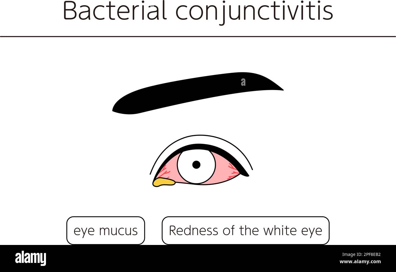 Medical Clipart, Line Drawing Illustration of Eye Disease and Bacterial Conjunctivitis, Vector Illustration Stock Vektor