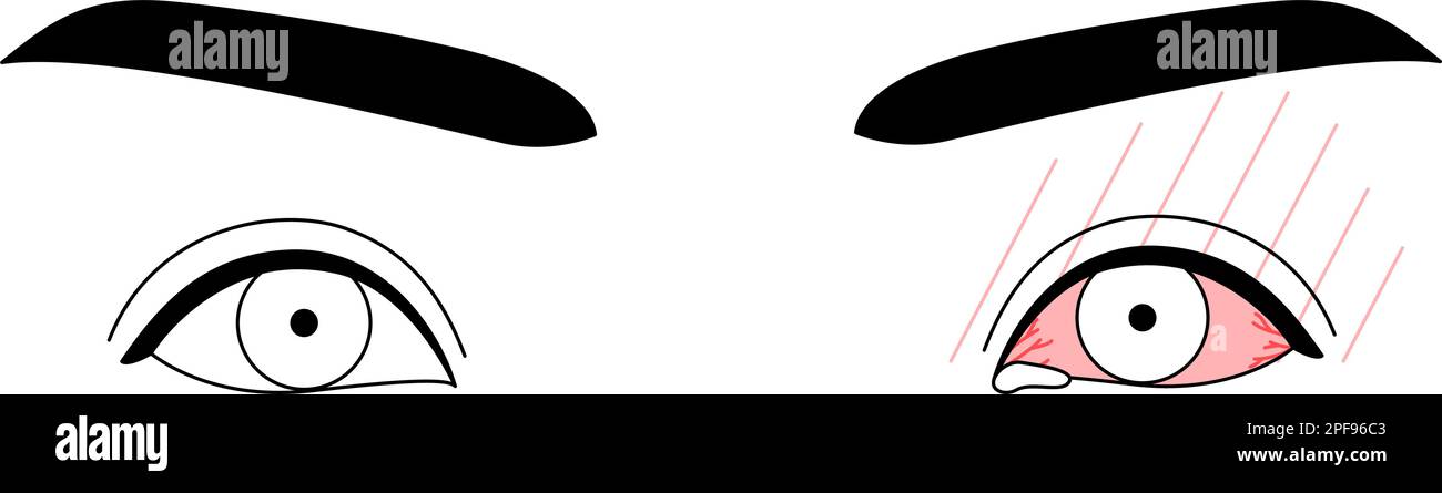 Medical Clipart, Line Drawing Illustration of Eye Disease and allergical Conjunctivitis, Vector Illustration Stock Vektor