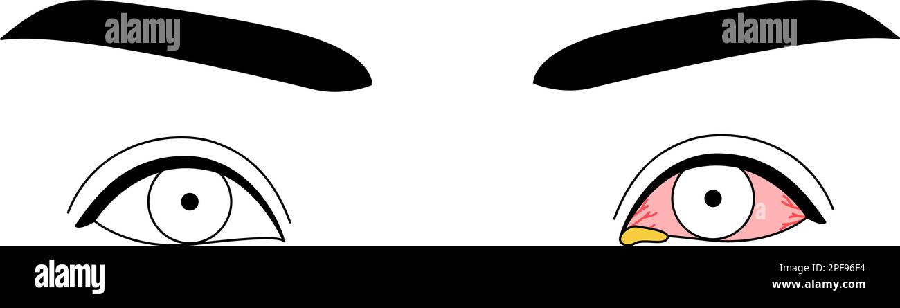 Medical Clipart, Line Drawing Illustration of Eye Disease and Bacterial Conjunctivitis, Vector Illustration Stock Vektor