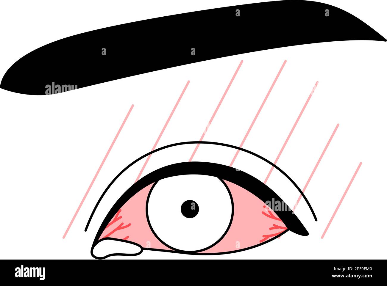 Medical Clipart, Line Drawing Illustration of Eye Disease and allergical Conjunctivitis, Vector Illustration Stock Vektor