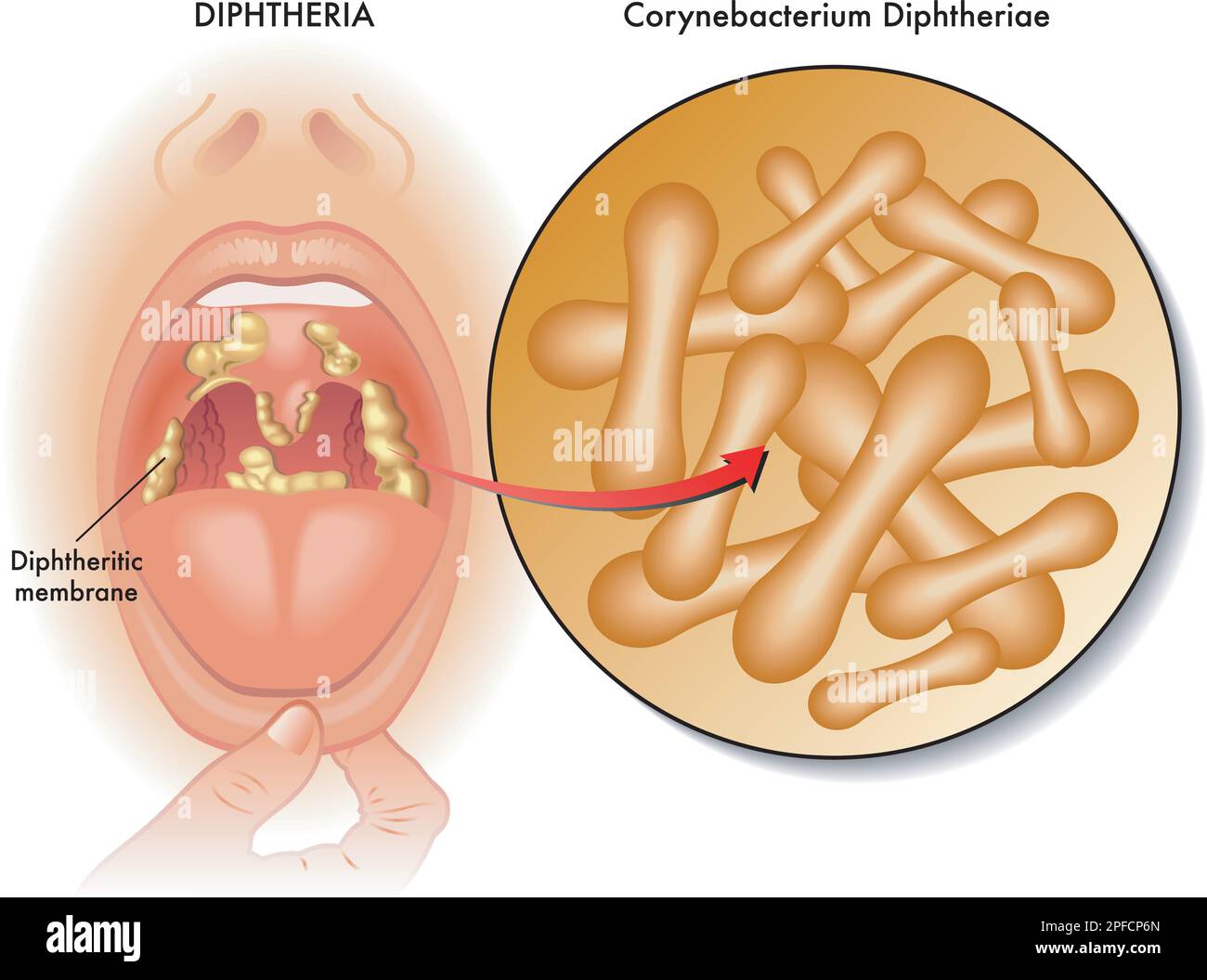 Medizinische Illustration der Symptome der Diphtherie, mit Anmerkungen. Stock Vektor