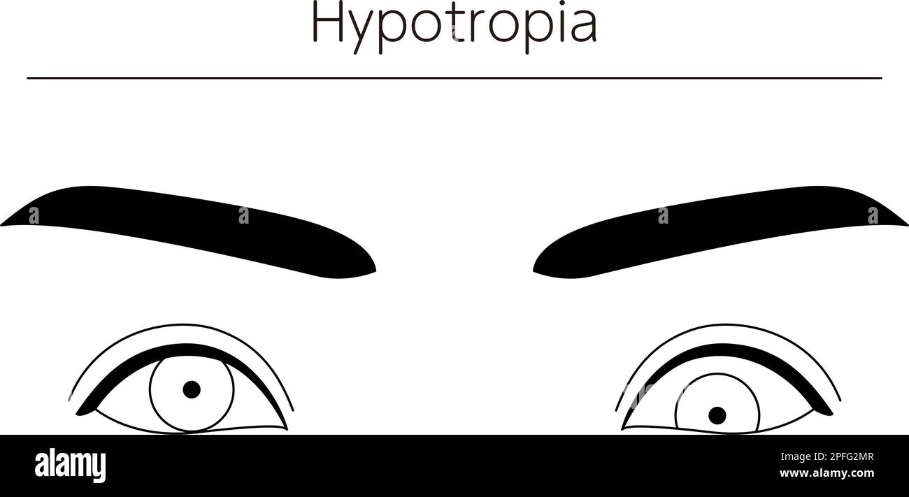 Medizinische Illustrationen, schematische Linienzeichnungen von Augenerkrankungen, Schielen und Hypotropie, Vektordarstellung Stock Vektor