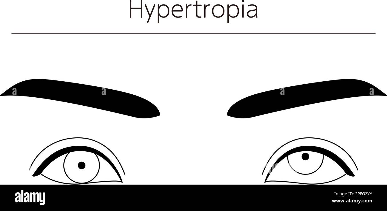 Medizinische Illustrationen, schematische Linienzeichnungen von Augenerkrankungen, Schielen und Hypertropie, Vektordarstellung Stock Vektor