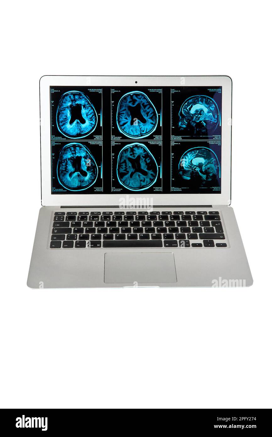 Magnetresonanztomographie des menschlichen Gehirns auf einem Computerbildschirm zur neurologischen medizinischen Diagnostik menschlicher Hirnerkrankungen. Stockfoto