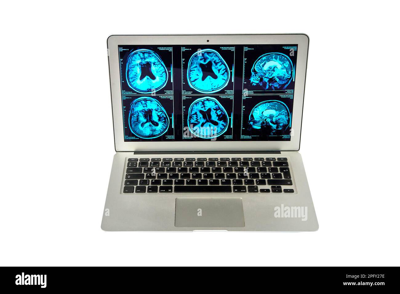 Magnetresonanztomographie des menschlichen Gehirns auf einem Computerbildschirm zur neurologischen medizinischen Diagnostik menschlicher Hirnerkrankungen. Stockfoto