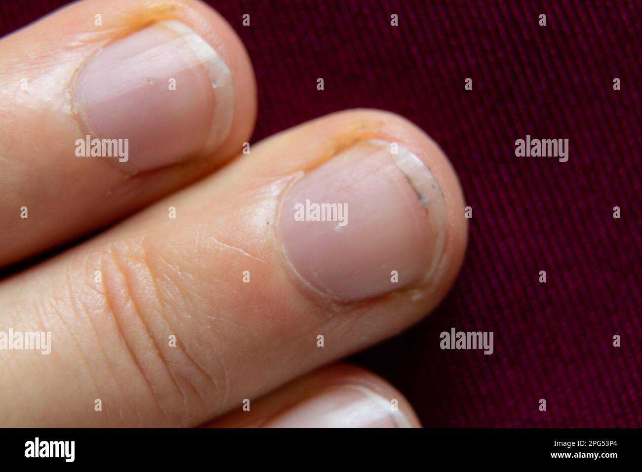 Fingernagelnaht ohne Maniküre-Nahaufnahme Stockfoto