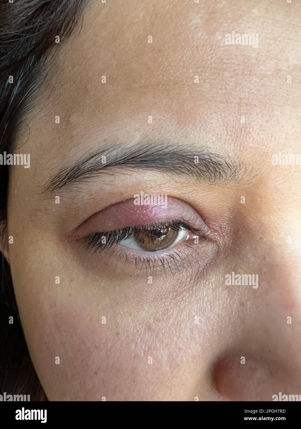 Nahaufnahme eines geschwollenen Augenlids aufgrund einer bakteriellen Infektion, eines roten, geschwollenen und juckenden reizbaren Auges, eines schmerzhaften roten Styens. Stockfoto