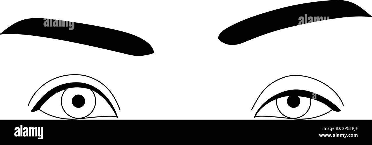 Medizinische Illustration: Diagramm der mittelschweren Ptosis (herabhängendes Augenlid), Vektordarstellung Stock Vektor