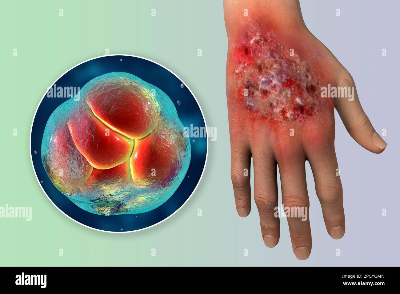 Protothekose-Infektion an einer menschlichen Hand, Illustration Stockfoto