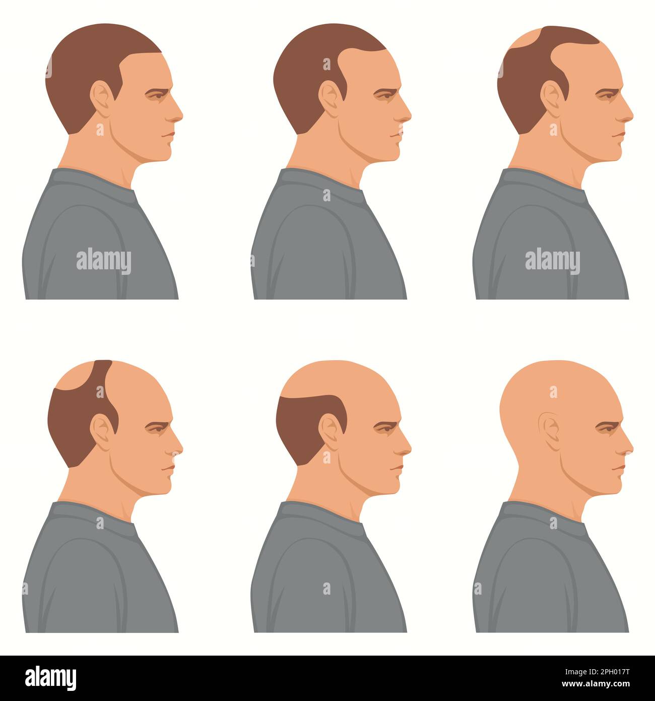 Haarverluststadien Vektor isoliert. Die männliche Alopezie. Satz des Glättungsprozesses. Haarlose Männerköpfe, Seitenansicht. Stock Vektor