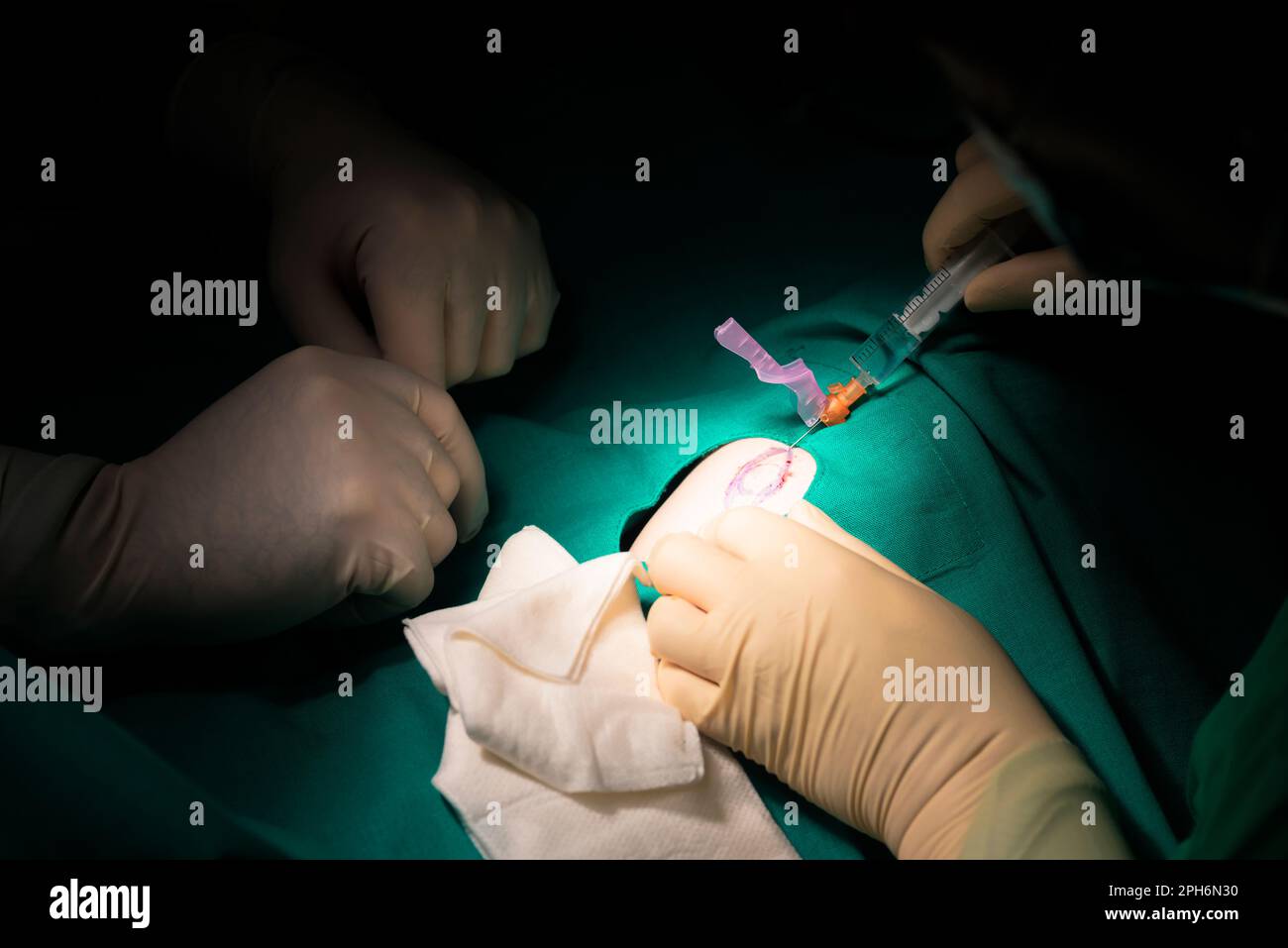 Lokale betäubung hand -Fotos und -Bildmaterial in hoher Auflösung – Alamy