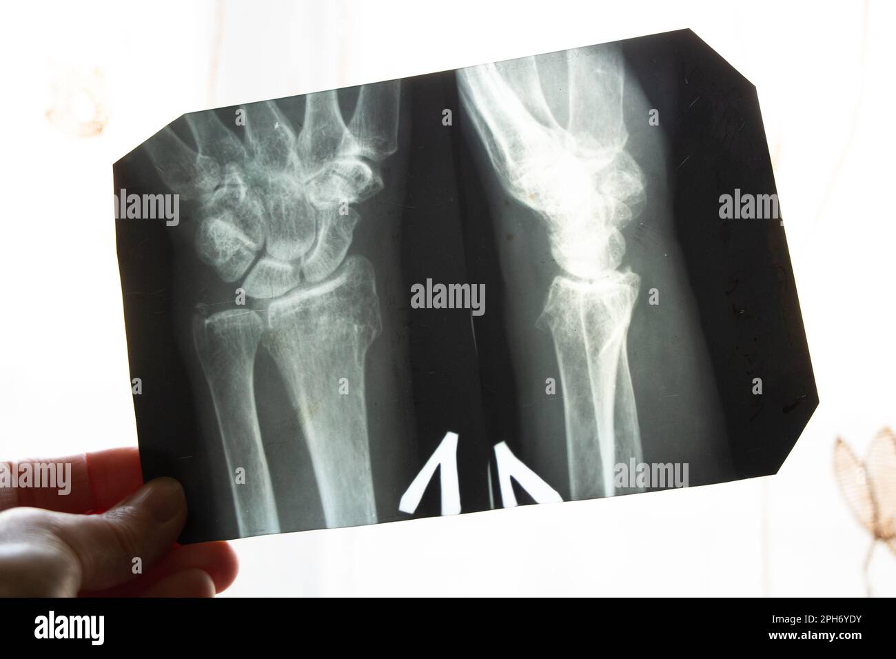 Röntgenbild eines älteren Menschen mit Osteoporose und Arthrose, Knochendestruktion, Diagnose und Behandlung Stockfoto