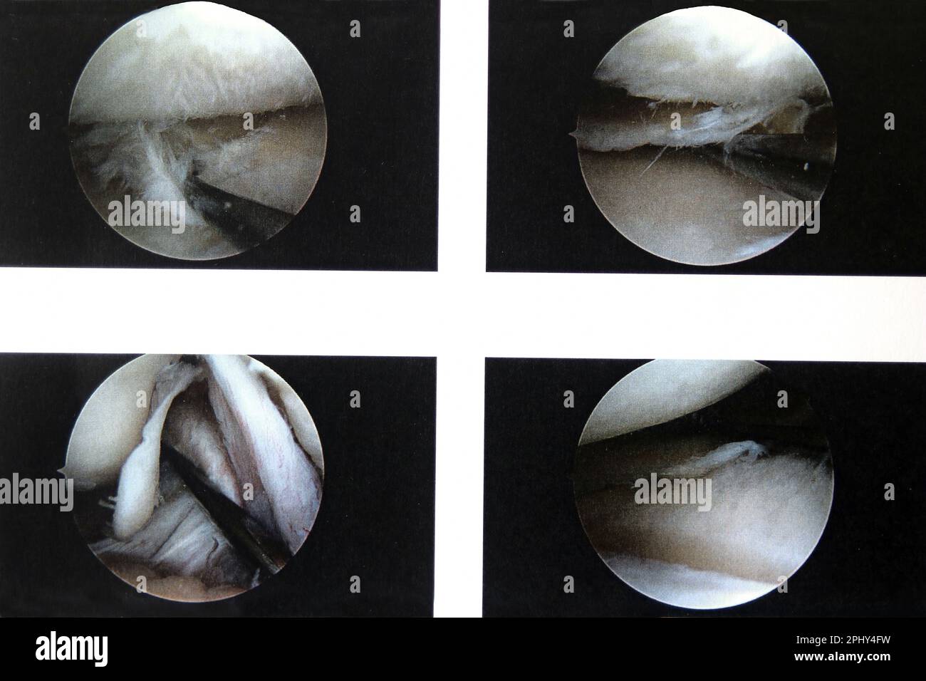 , Arthroskopie Stockfoto