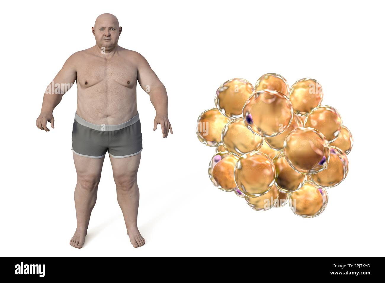 Übergewichtiger Mensch und Fettzellen, Illustration Stockfoto