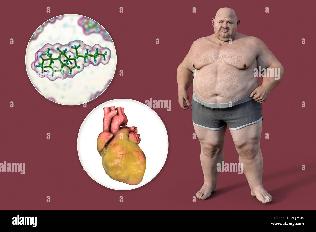 Cholesterin und Fettherz beim übergewichtigen Mann, Illustration Stockfoto