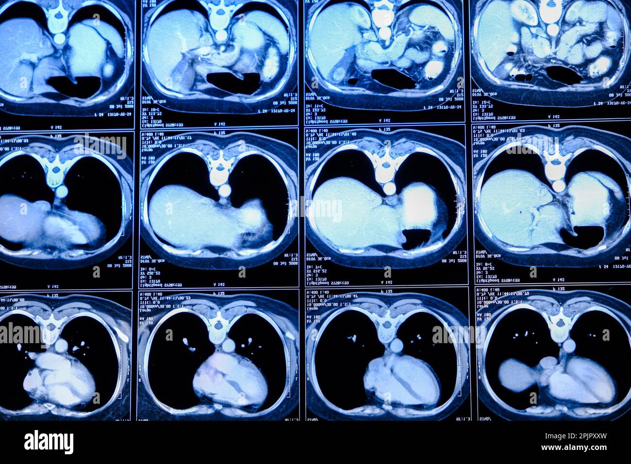 Computertomographie (CT-Scan) des Thorax mit Abdomen Stockfoto