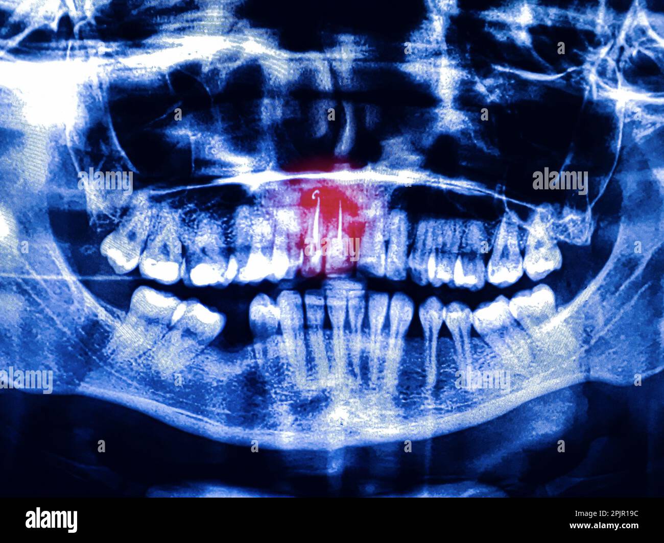 Panorama-Dentalröntgenuntersuchung, zwei Wurzelkanalbehandlungen mit rotem Bereich Stockfoto