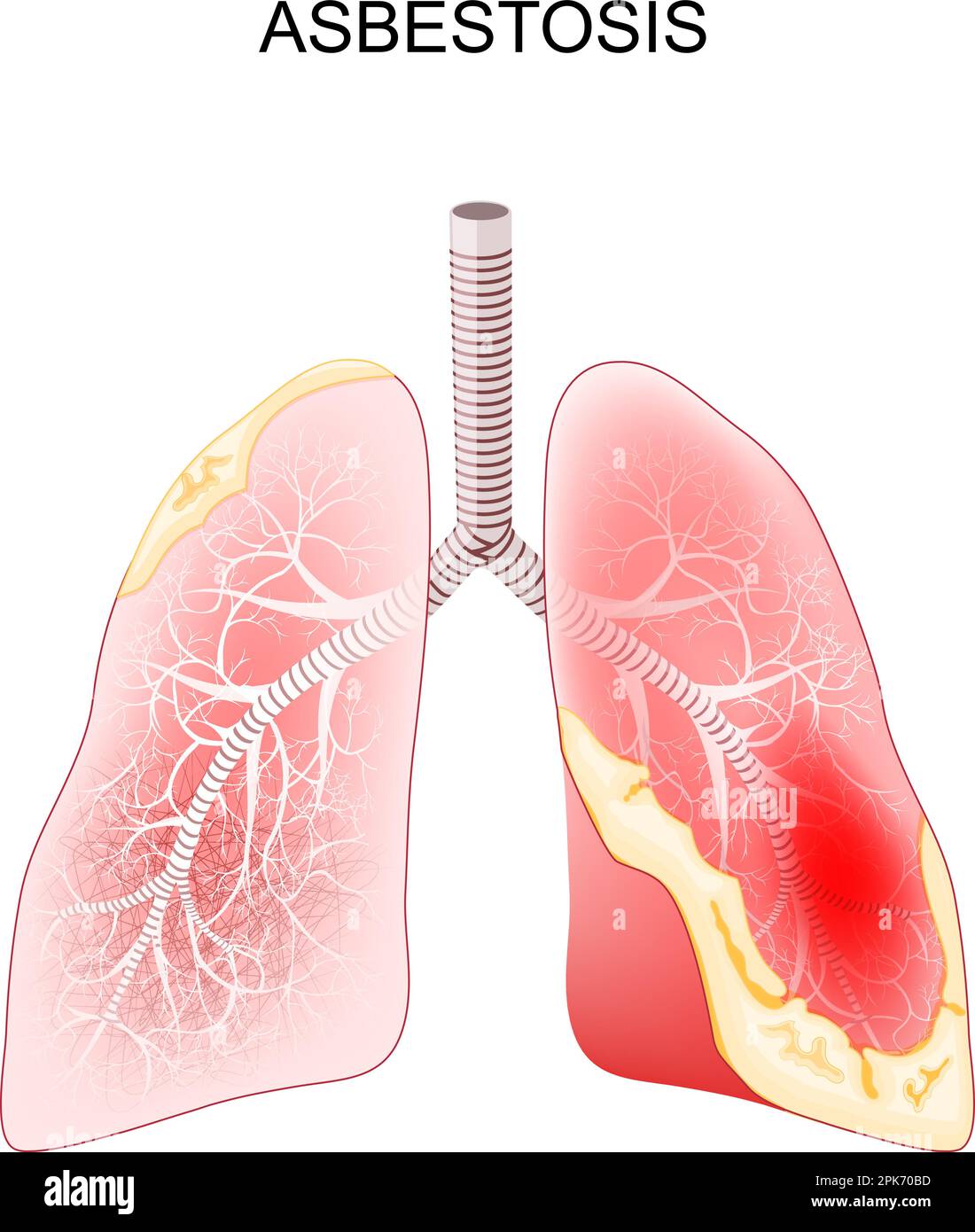 Asbestose. Lungenerkrankung als Folge der Asbestfaserexposition. Nahaufnahme eines Querschnitts menschlicher Lungen mit Fibrose und Narbenbildung. Vektor Stock Vektor