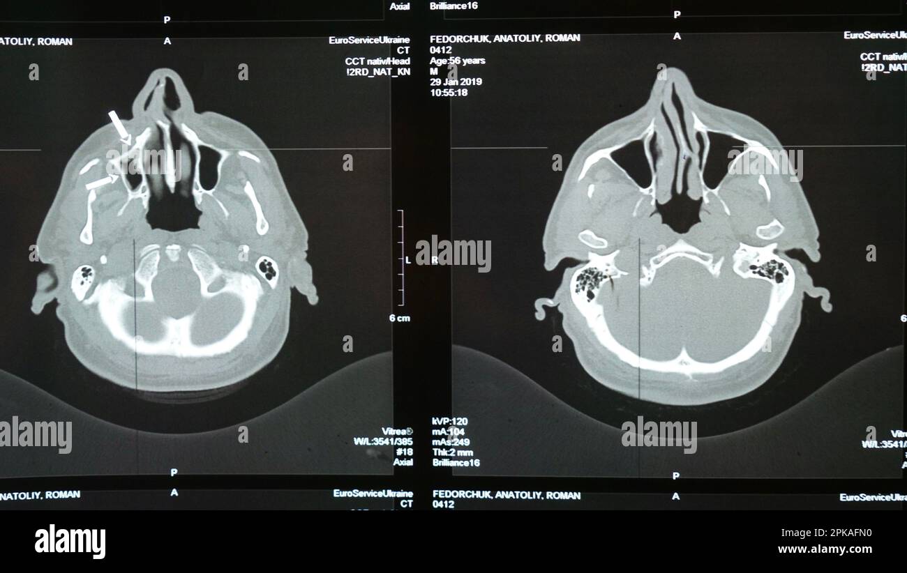 Magnetresonanztomographie des Gehirns eines älteren Mannes nach einer traumatischen Hirnverletzung, die zeigt, dass das Gehirn geschädigt ist. Tomographisches Bild des Kopfes. Untersuchung durch einen Neurologen Stockfoto