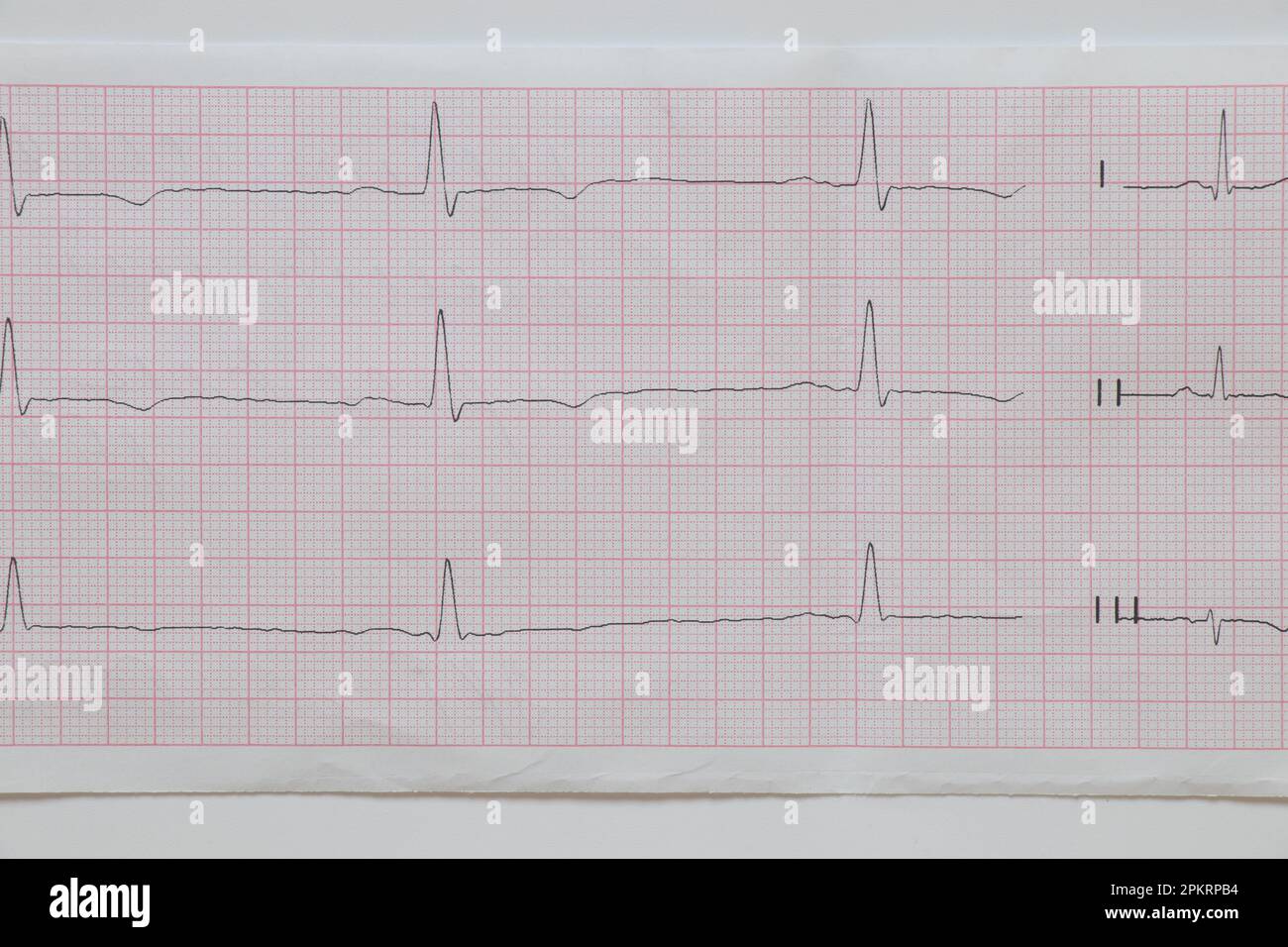 Das Kardiogramm liegt auf weißem Hintergrund, Diagnose und Untersuchung des Herzens Stockfoto