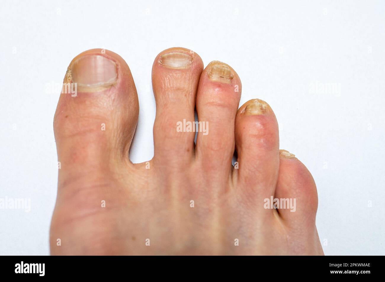 Nahaufnahme eines erwachsenen männlichen Fußes mit drei kleinen Zehen, die mit Nagelmykose (Onychomykose) infiziert sind. Stockfoto