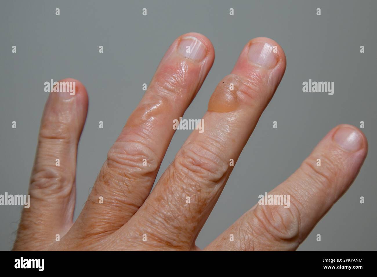 Typische Hautblasen bei Verbrennungen durch kochendes Öl zweiten Grades. Stockfoto