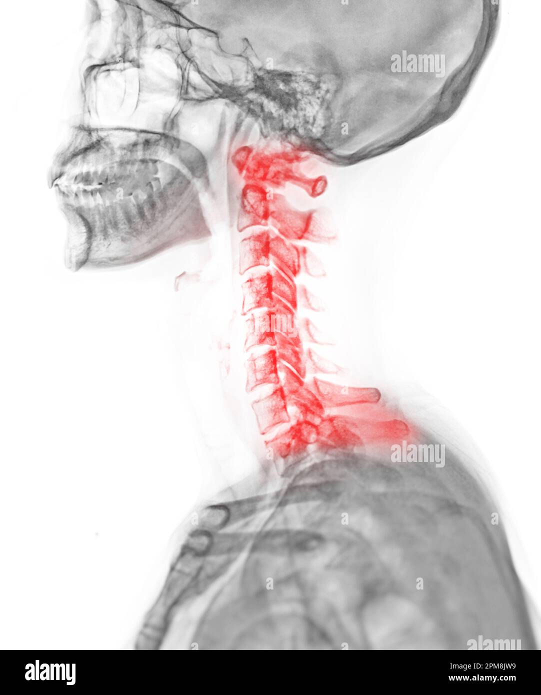 Röntgen-HWS- Oder Röntgenbild Der Halswirbelsäule In Lateraler Sicht ...