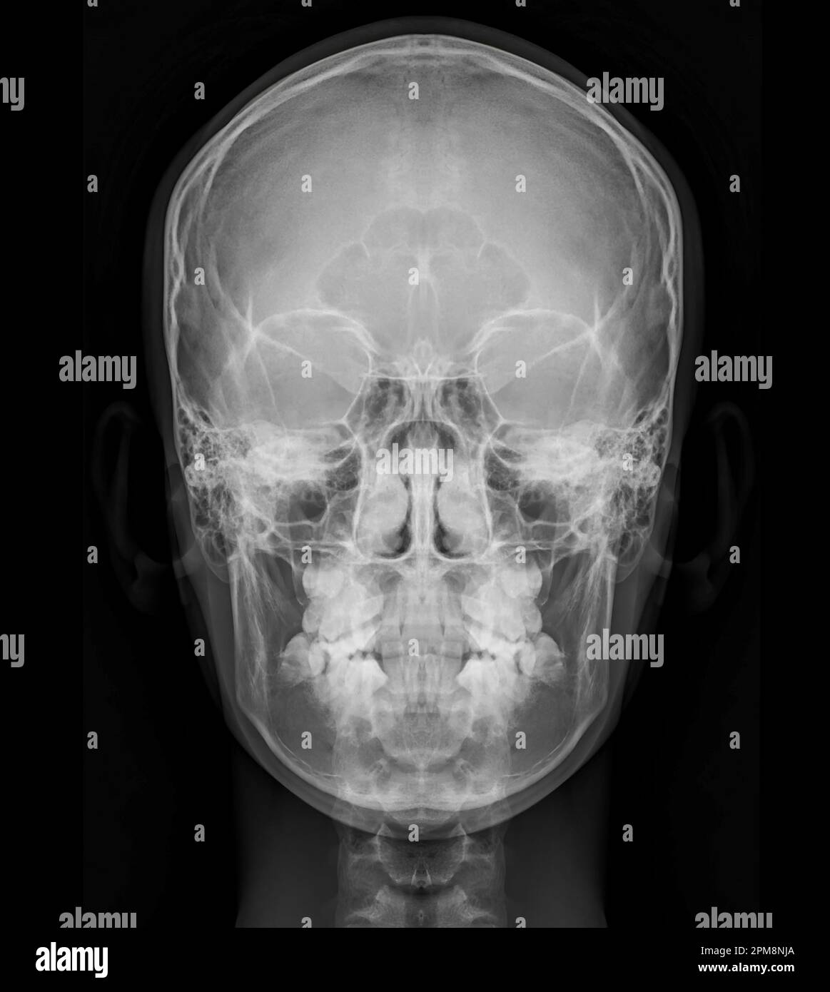 Röntgenbild des menschlichen Schädels Vorderansicht zur Diagnose einer Schädelfraktur isoliert auf schwarzem Hintergrund. Stockfoto