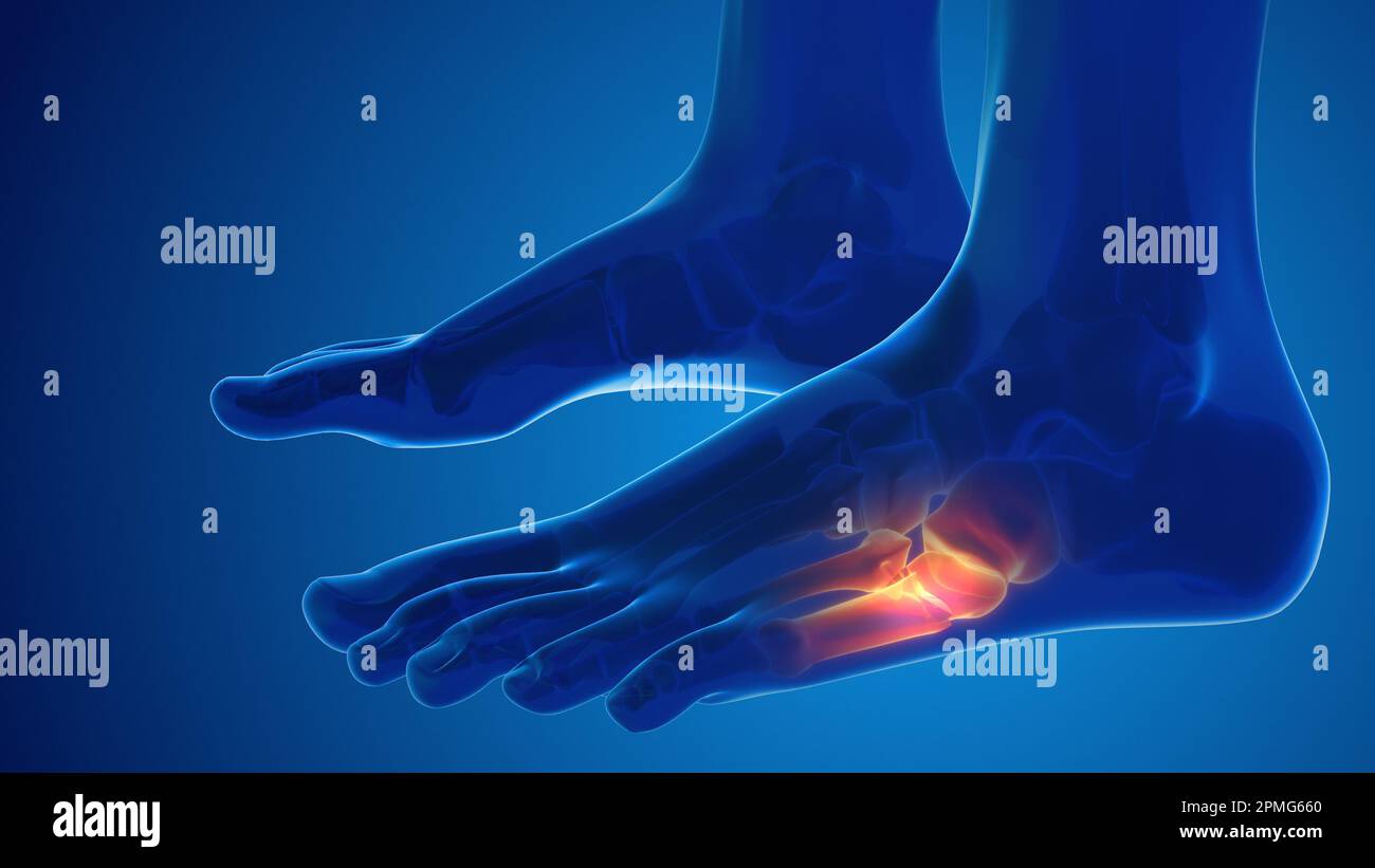 Medizinisches Konzept für gebrochene Fussknochenschmerzen Stockfoto