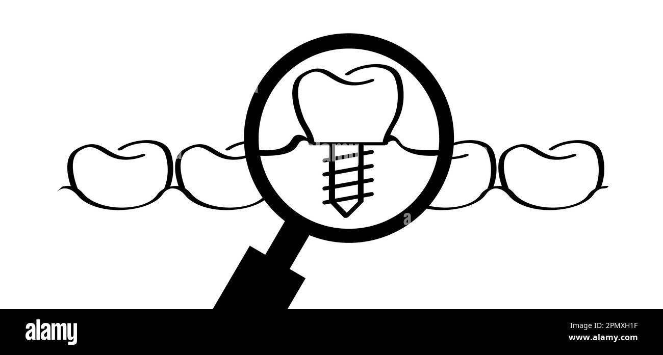 Zahnimplantat, medizinisch korrekt oder Zahnbrücke. Cartoon gesund, Zahn mit Zahnfleisch. Molares Linienmuster. Zahn mit Schraube ziehen. Beschädigte Zähne oder t Stockfoto