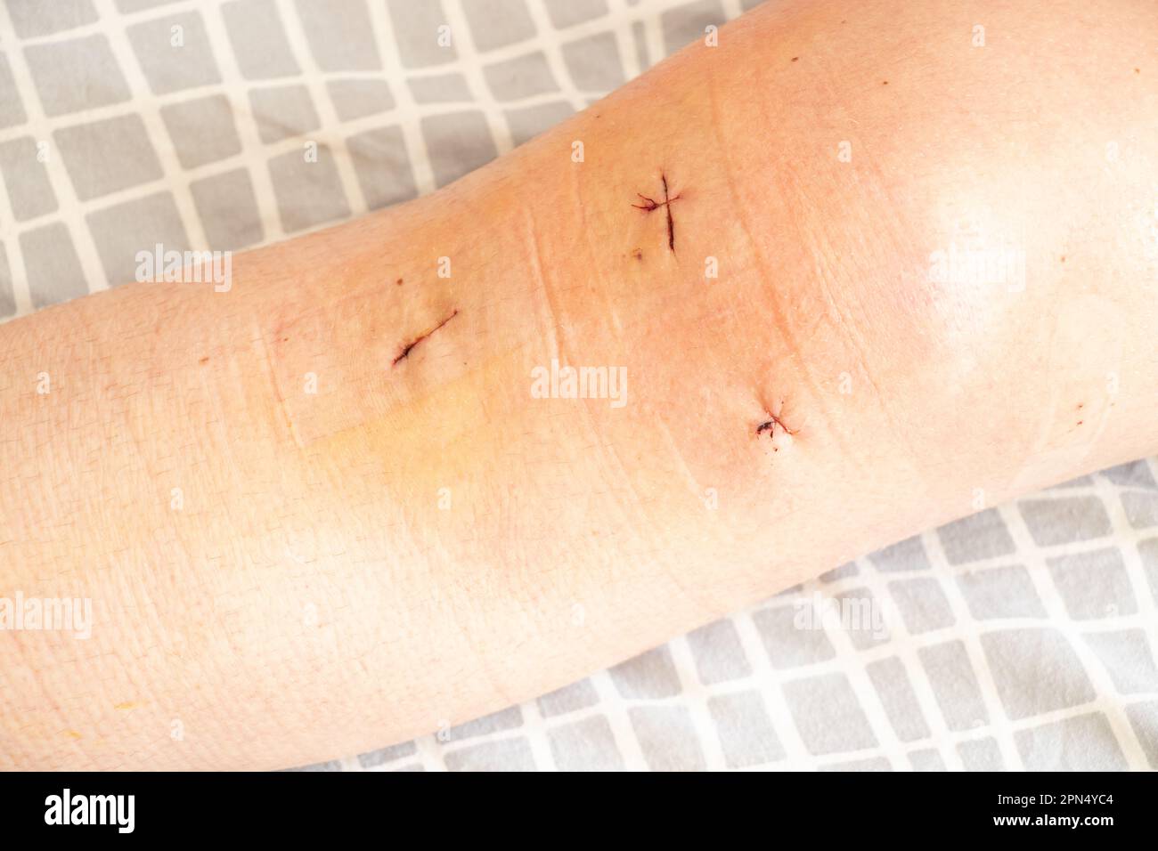Genähte Wunde Blutet Nach 1 Woche www.alamy.de