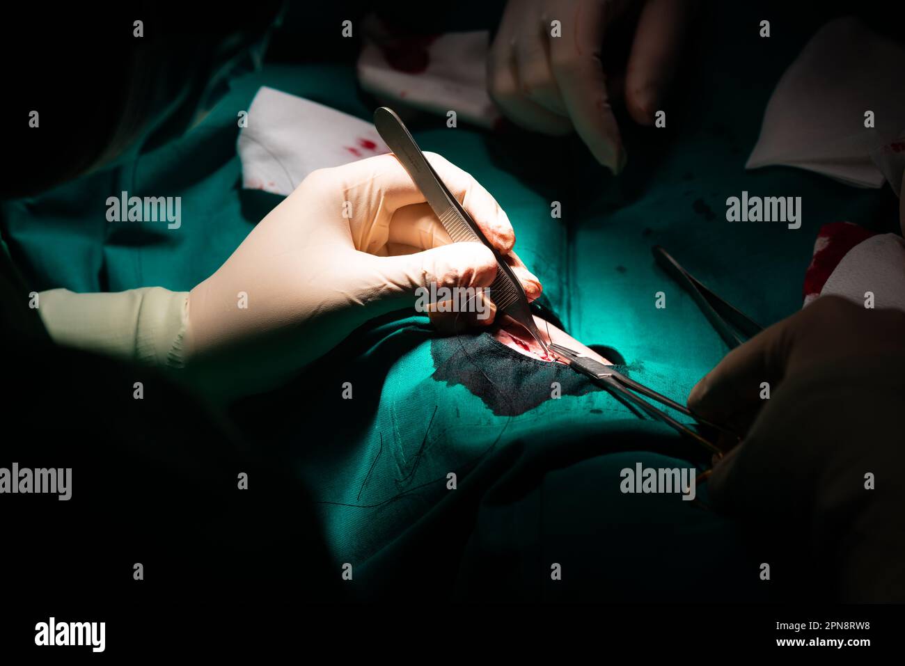 Nahaufnahme eines Chirurgen, der die Haut nach Entfernung einer dermatologischen Läsion verschließt. Naht mit Nadelhalter, Seidennaht, Pinzette und sterilem Glo Stockfoto