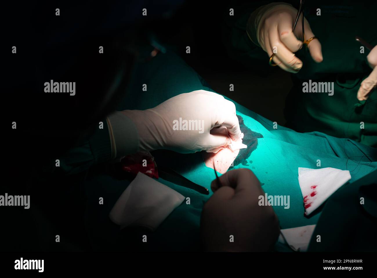 Nahaufnahme der Hände eines Chirurgen, der die Haut während der Naht mit sterilem Verbandmull reinigt. Naht mit Nadelhalter, Seidennaht, Pinzette und sterilen Handschuhen Stockfoto
