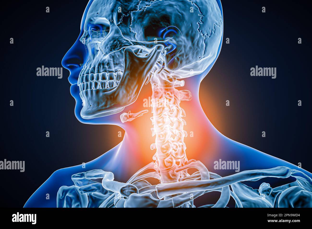 Halswirbelsäule mit Arthrose, Entzündung oder Verletzung 3D-Darstellung. Anatomie, Wirbelsäulenpathologie, Gelenkschmerzen oder -Erkrankungen, Rheuma Stockfoto