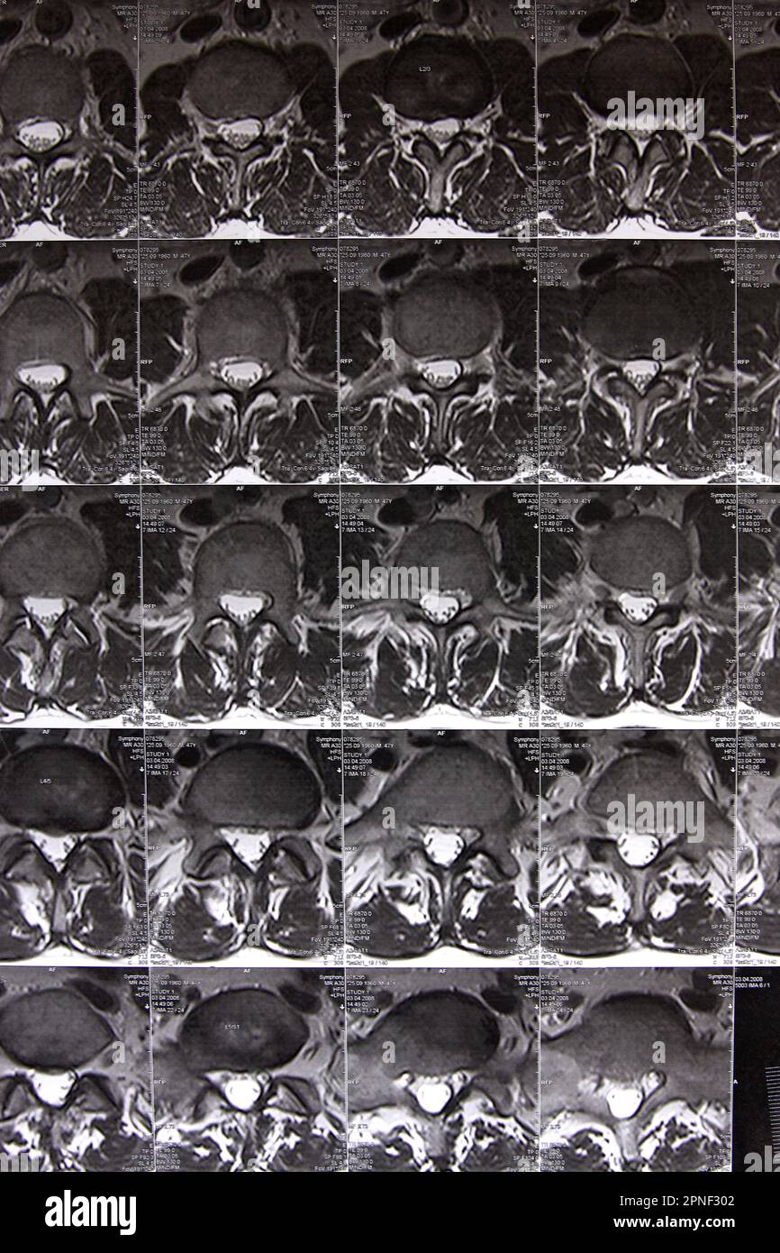 Magnetresonanztomographie der Wirbelsäule Stockfoto