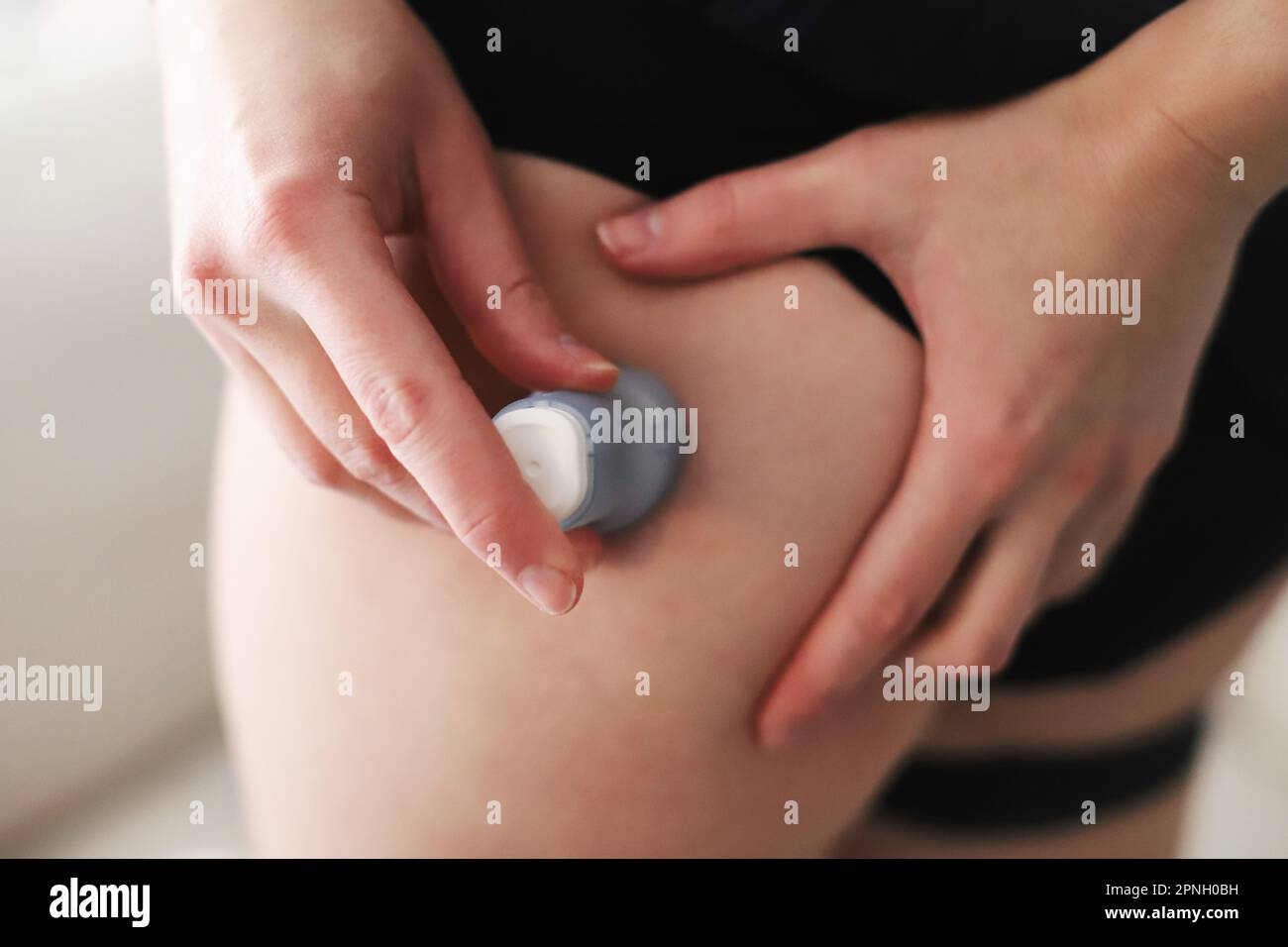 Frau, die ein Infusionsset zur Insulinverabreichung in ihren Körper einsetzt Stockfoto