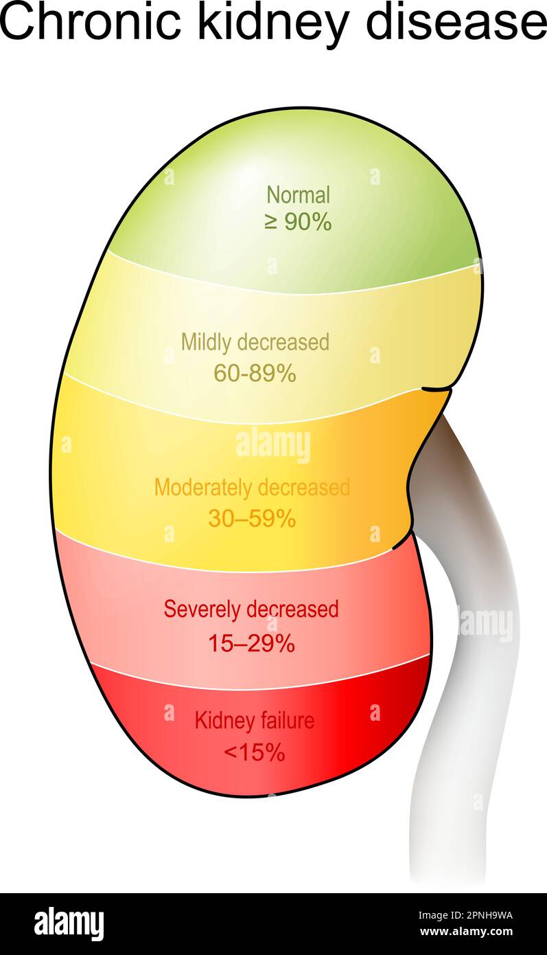 Chronische Nierenerkrankung. Krankheitsstadium von normal und leicht herabgesetzt bis zu Nierenversagen. EGFR-Testergebnis und wie Nieren Blut filtern Stock Vektor