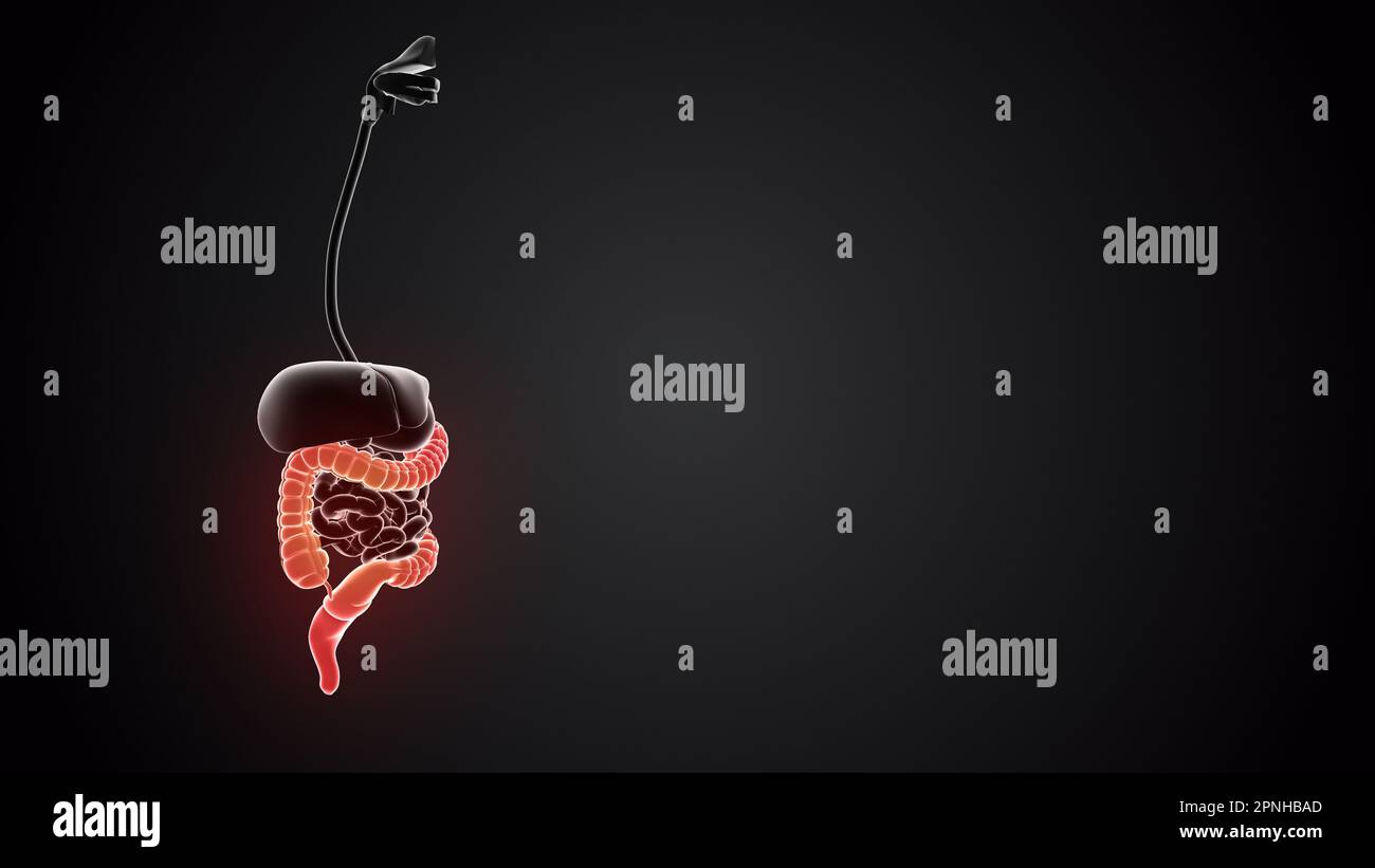 Menschlicher Körper mit Dickdarm Stockfoto