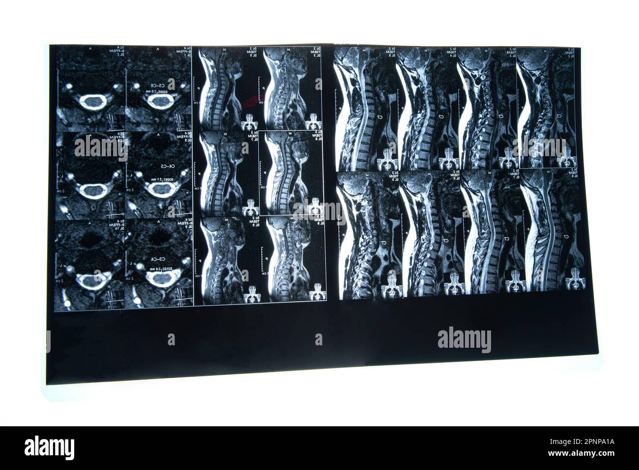MRT-Röntgenfilmszintigraphie der sakro-lumbalen Wirbelsäule eines Patienten mit chronischen Rückenschmerzen Stockfoto